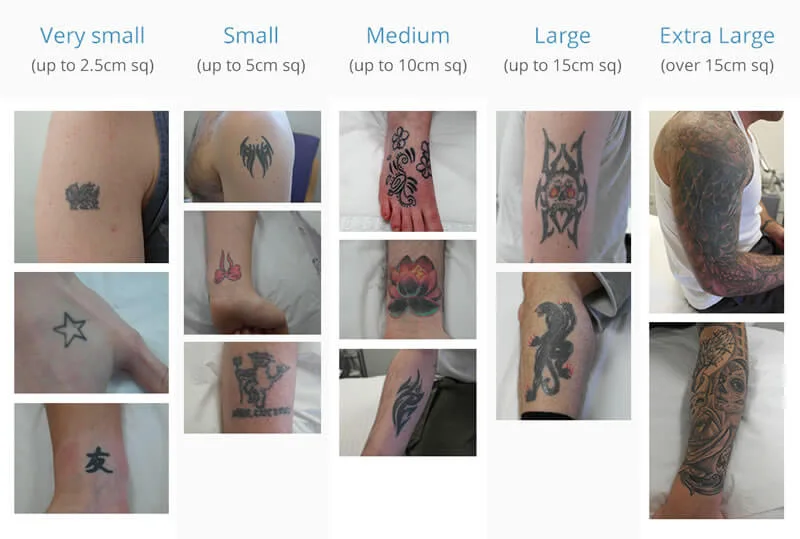 price laser tattoo removal in essex