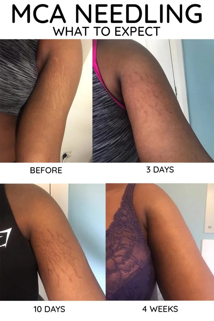 Scar & Brazilian Stretch Mark Tattoo Camouflage FAQs