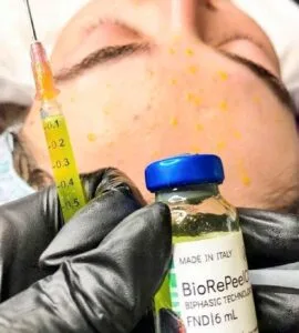 Biorepeel medium depth face peell pigmentation