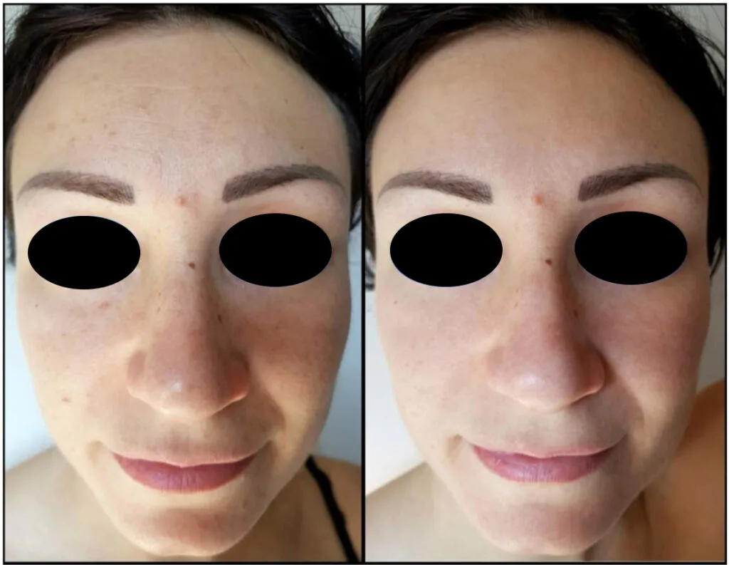 best pigmentation face peel
