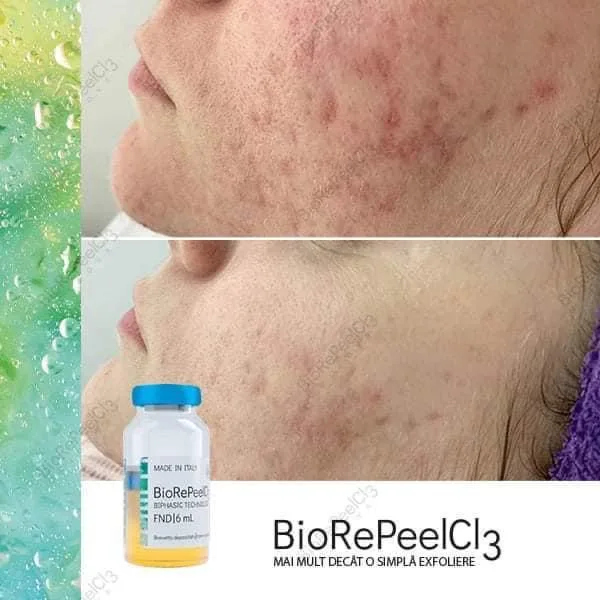biorepeel acne scarring face peel, BioRePeelCl3