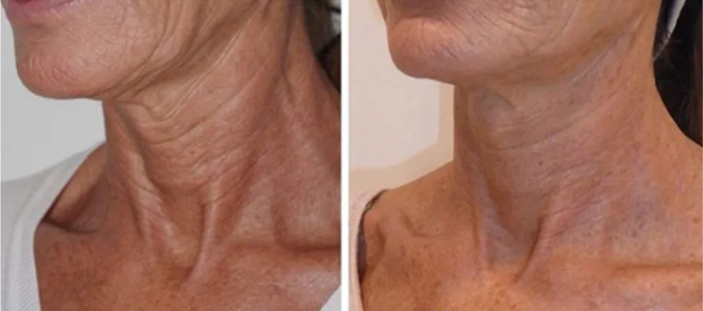 TCI medium peel Biorepeel