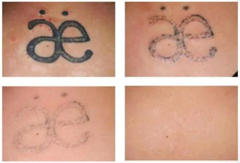Laser tattoo removal in London