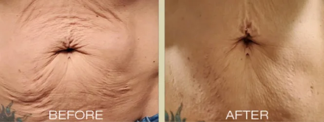 Stomach tightening with microneedling and radiofrequency