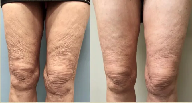 thigh skin tightening witih radiofrequency and microneedlng