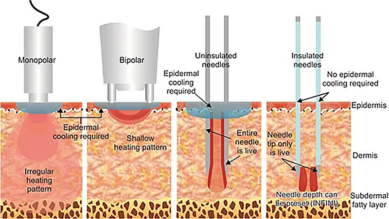 insulated vs non-insulated RF needles