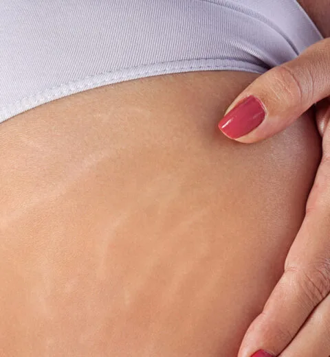 stretch mark treatment in London