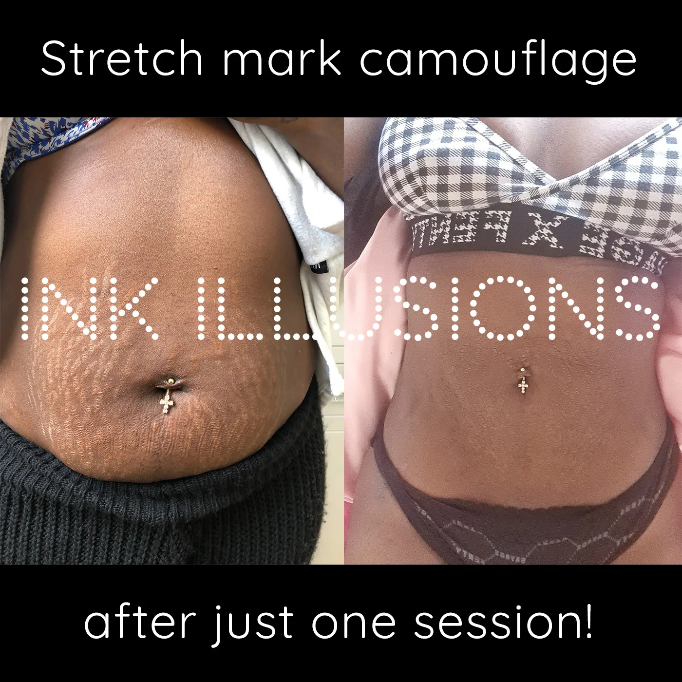 inkless stretch mark treatment on darker skin stomach