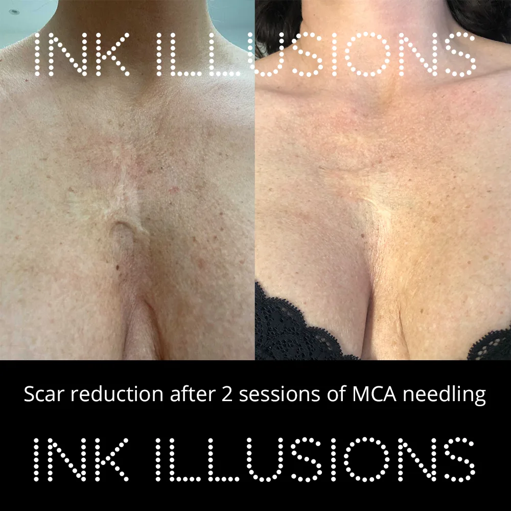 burn scar relaxation treatment London