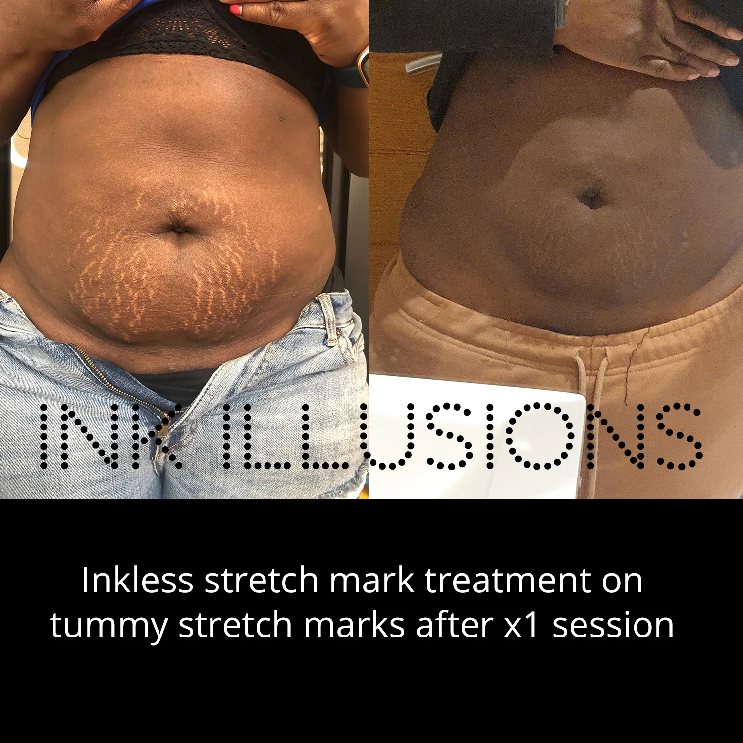 pregnancy stretch marks removal
