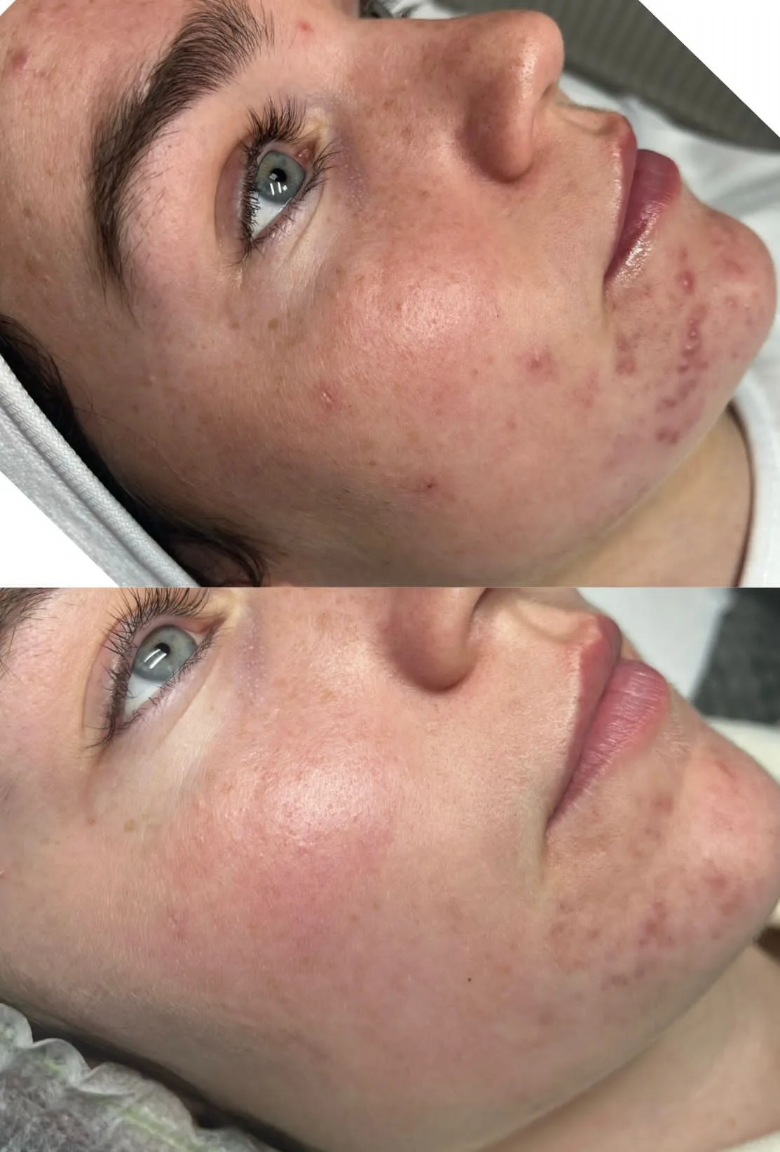 SQT facial before after, SQT Bio-microneedling