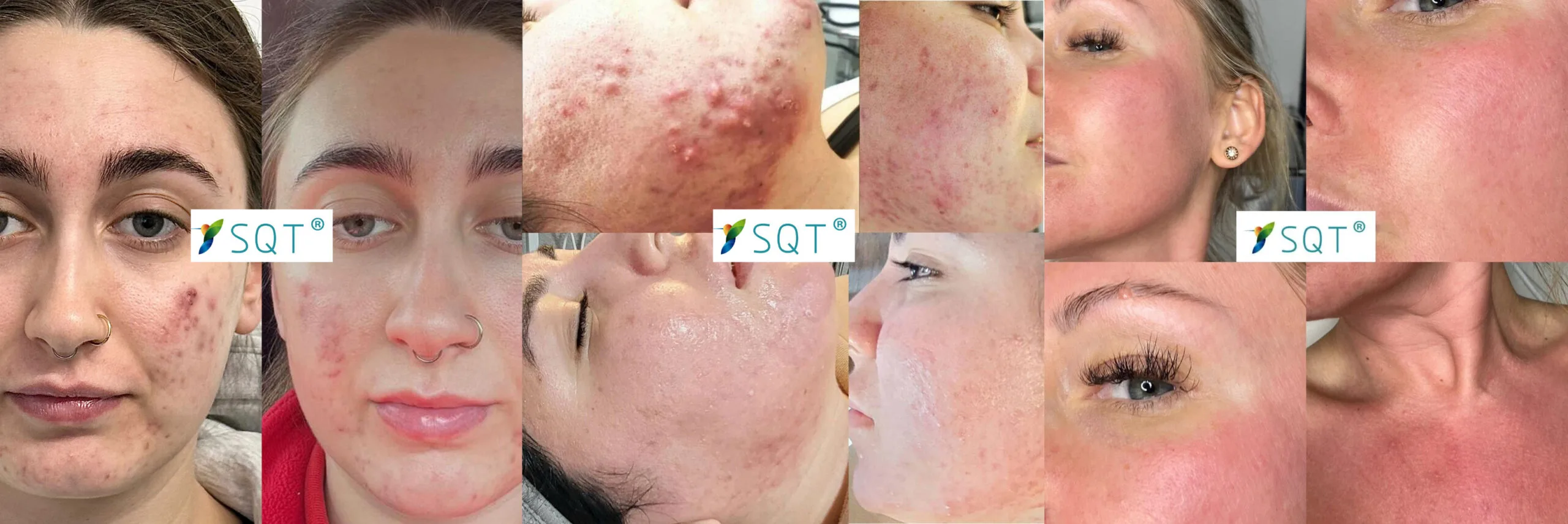 SQT bio-microneedling before after london
