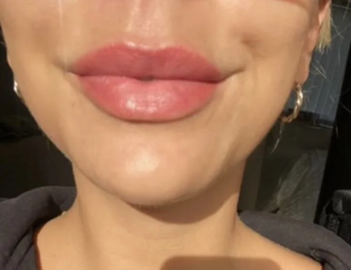 healed pmu lips london
