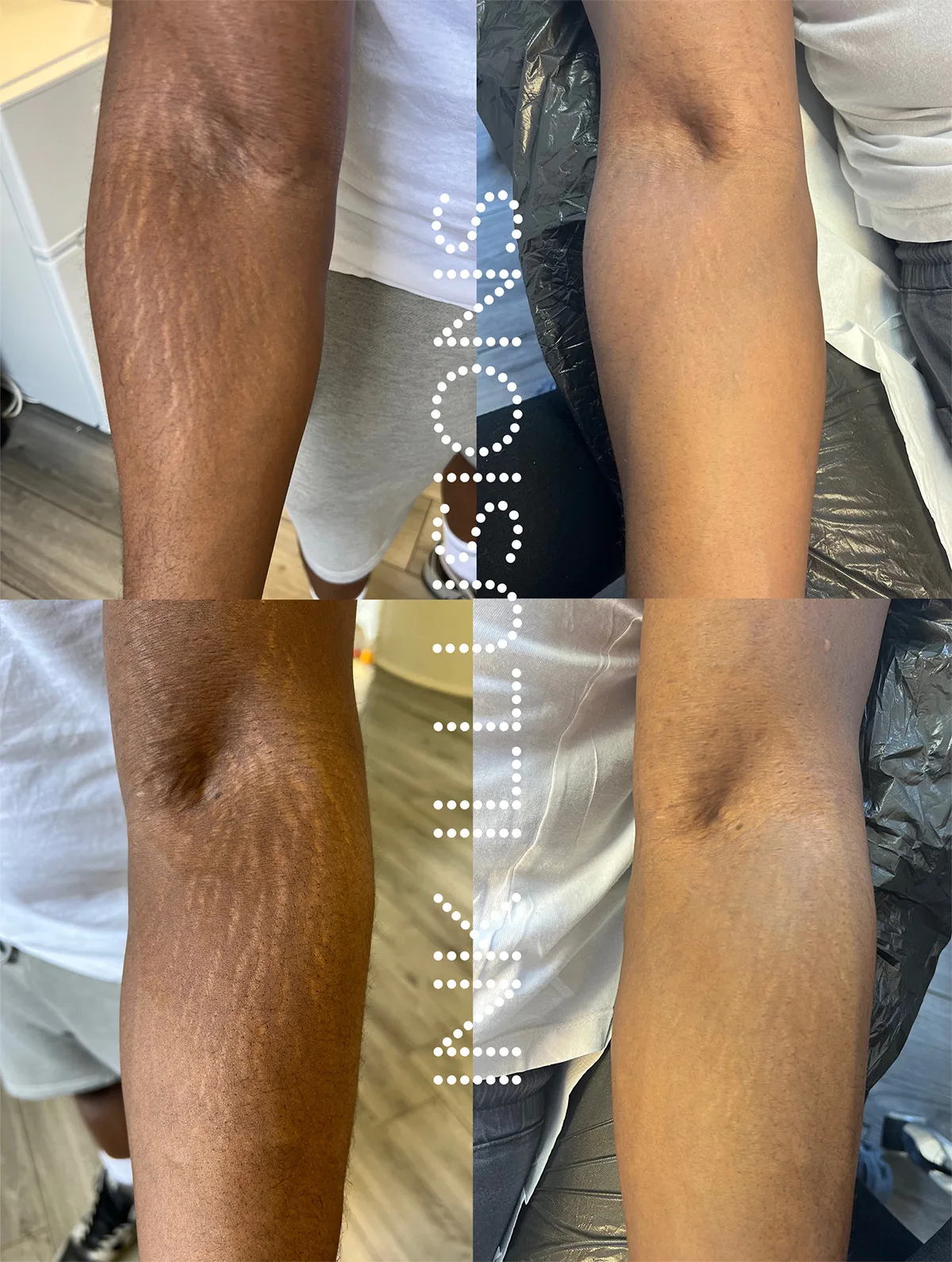MCA micro needling stretch marks