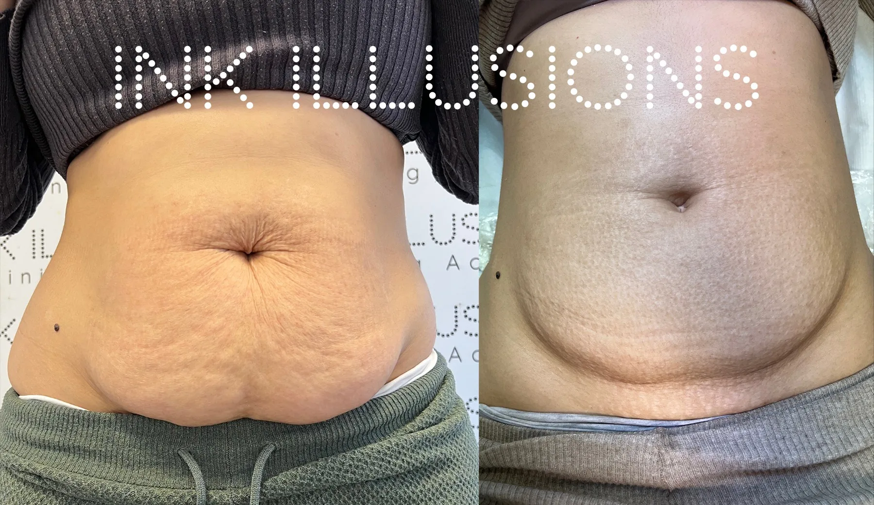 Radiofrequency Microneedling Training Course