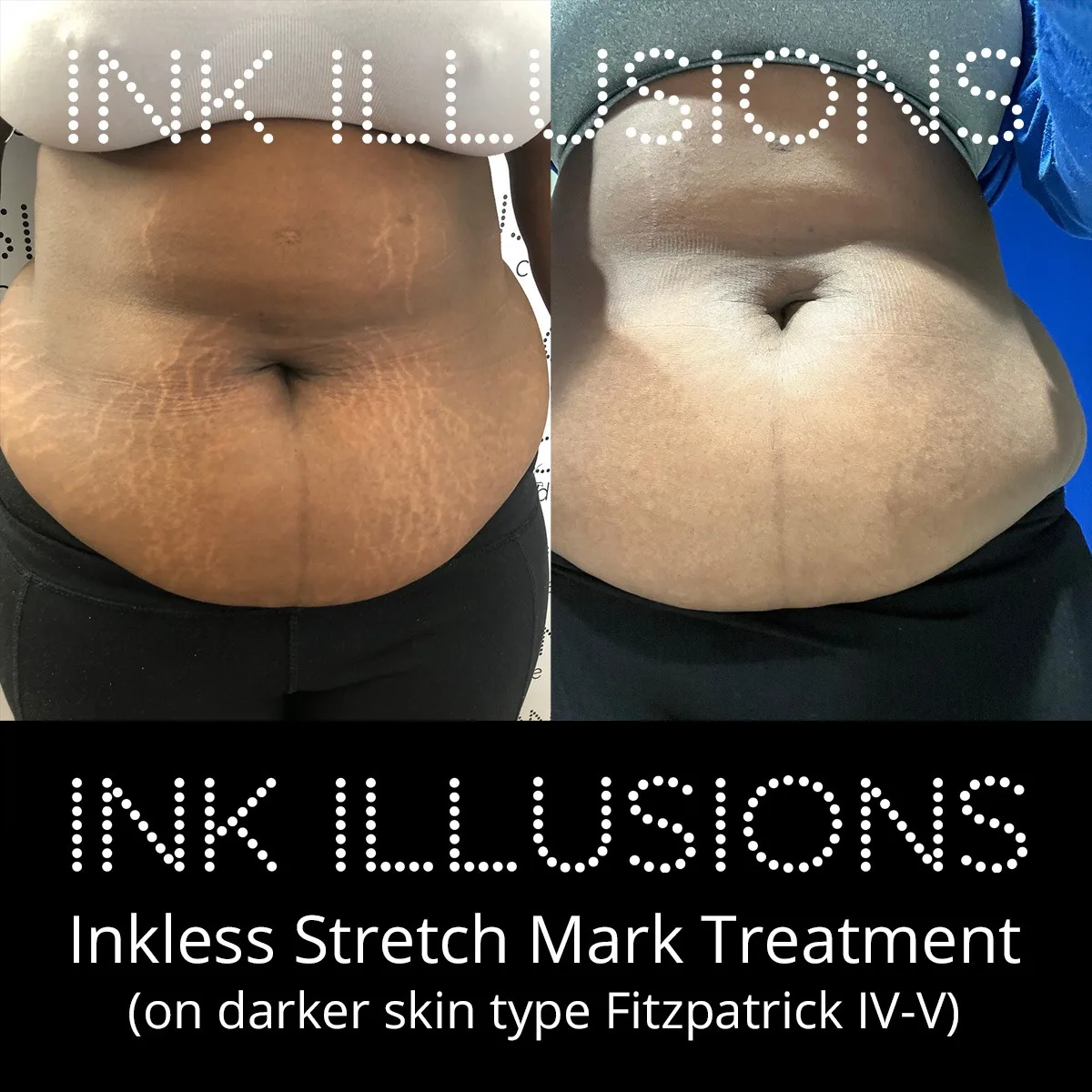 stomach stretch mark solution London