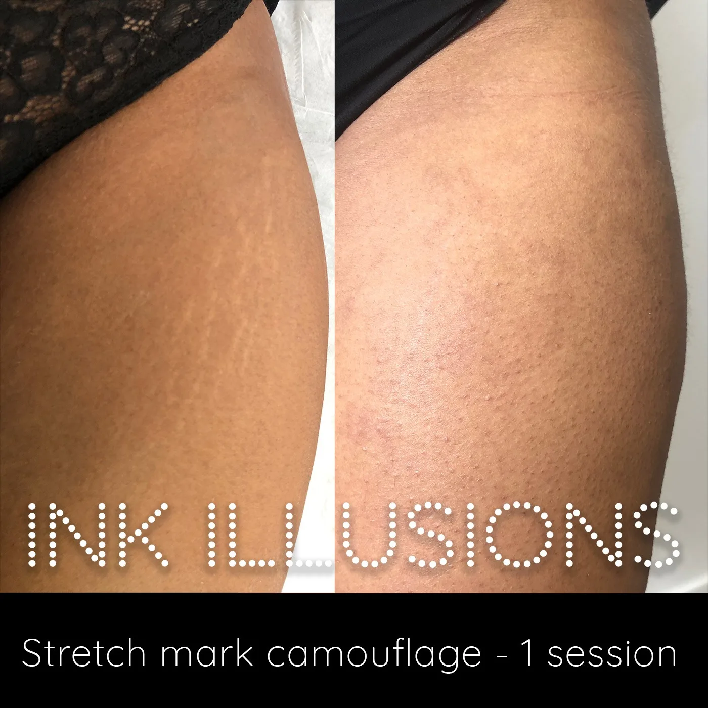 stretch mark camouflage london before after photos