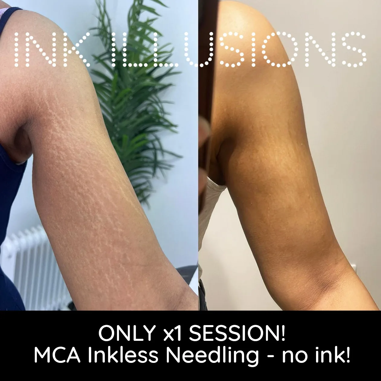 stretch mark treatment on arms