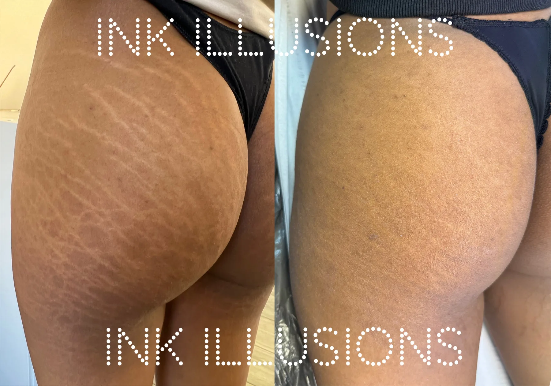 stretch mark removal in London not laser