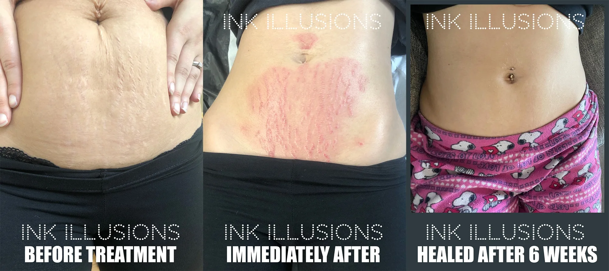 stomach stretch mark removal london