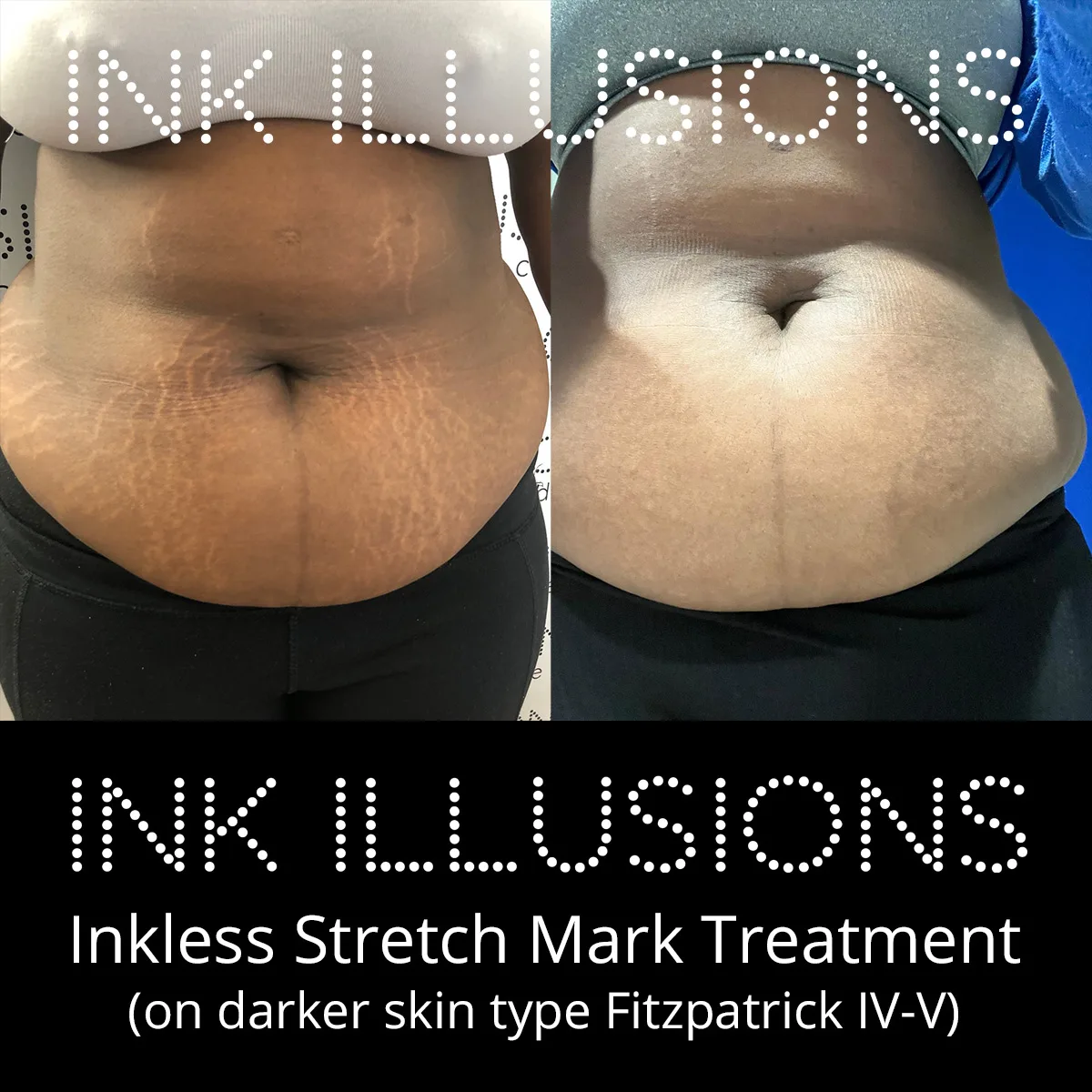 tummy stretch marks treated with inkless stretch mark revision london