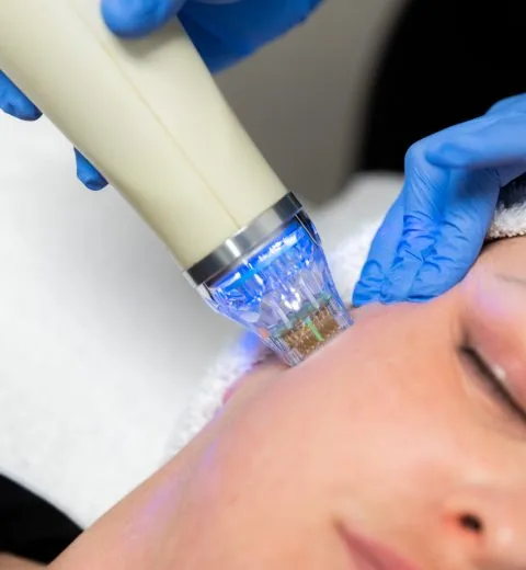 RF microneedling treatment in London