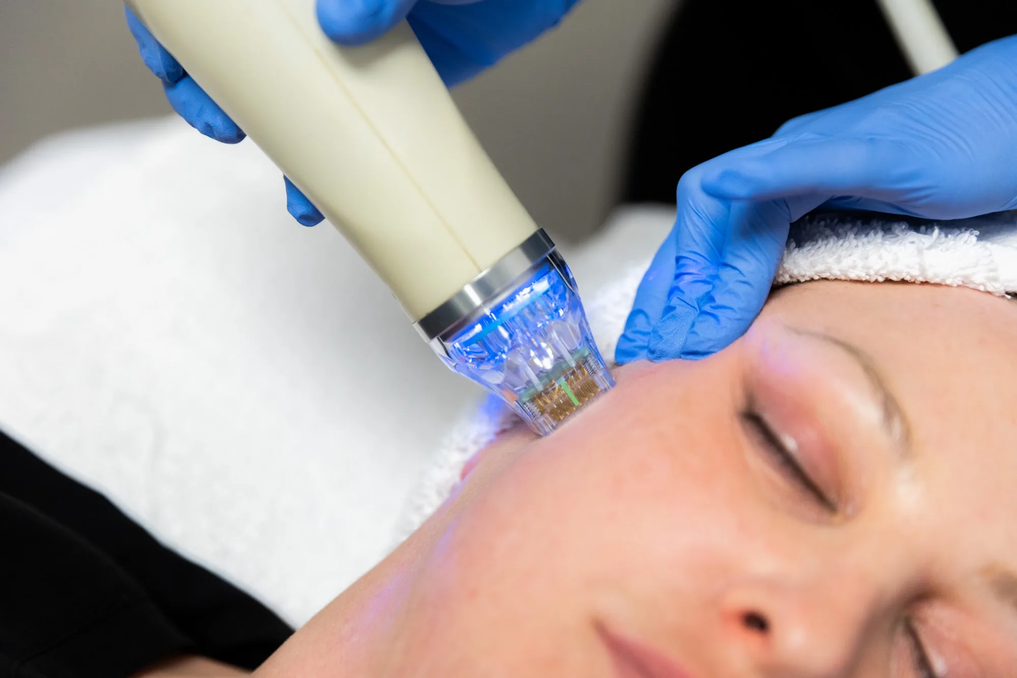 RF microneedling treatment in London