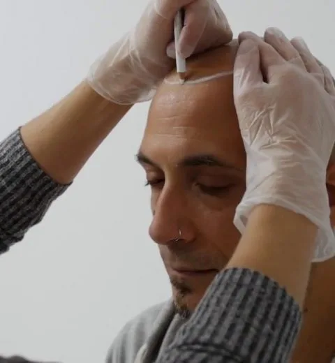 Scalp Micropigmentation UK