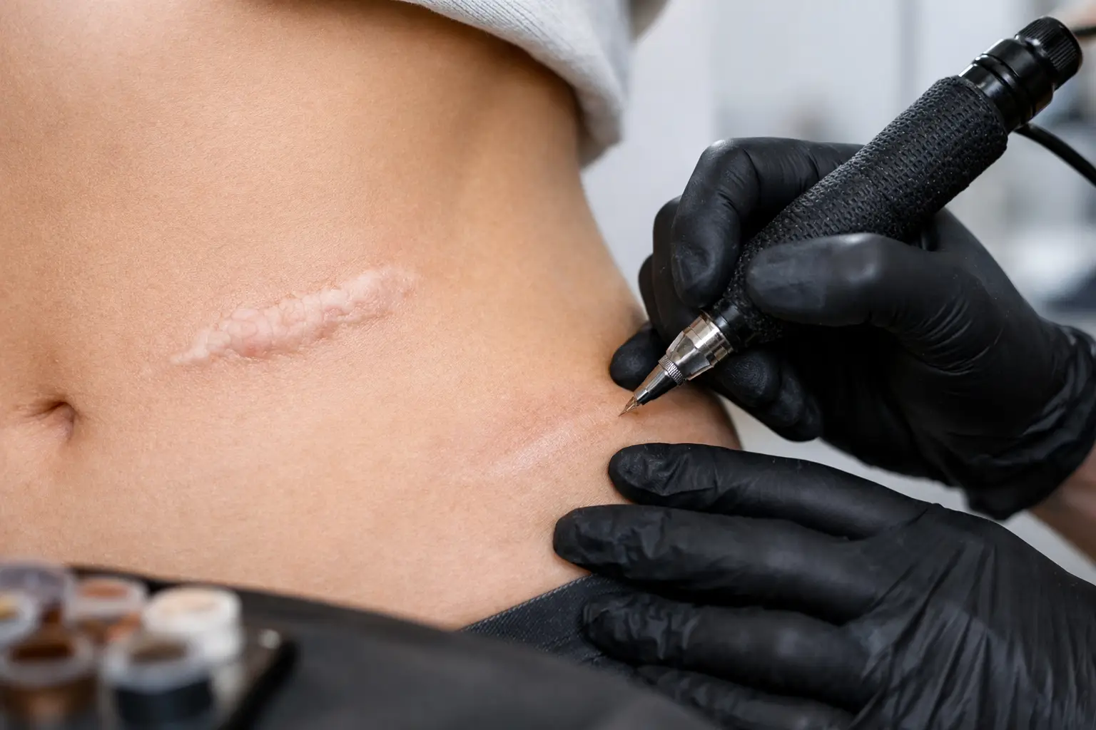 What Is Scar Camouflage Tattoo?